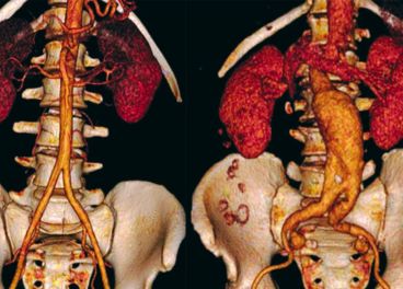 Aneurisma Abdominal
